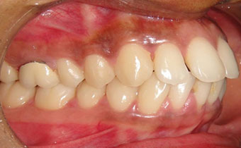 Forwardly-placed-teeth-Jaws2