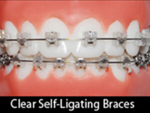 Self-Ligation-Braces2