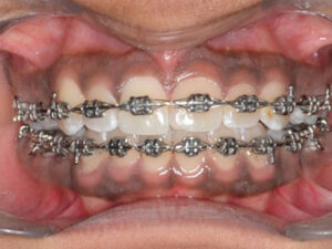 types-of-braces1